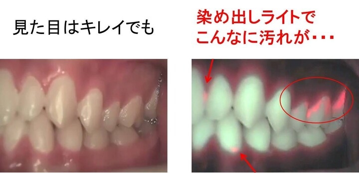 マスクの着用で歯磨きをさぼってませんか 歯垢 歯石検査 染め出しライト で 見えるデンタルケア 株式会社ローズクリエイトのプレスリリース マスクの着用で歯磨きをさぼってませんか 歯垢 歯石検査 染め出しライト で 見えるデンタルケア 株式会社ローズクリエイトのプレスリリース